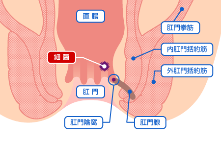 慢性裂肛イラスト