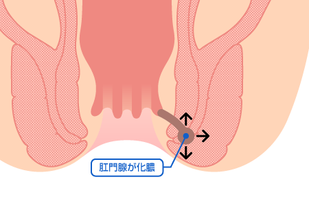 慢性裂肛イラスト