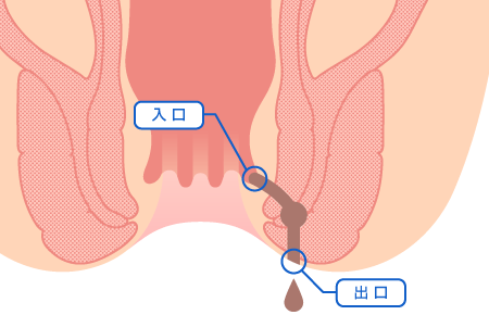 慢性裂肛イラスト