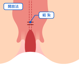 結紮切除術イラスト