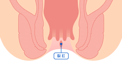 急性裂肛イラスト