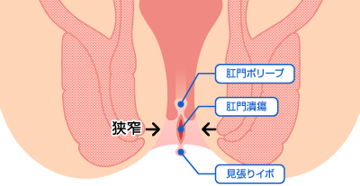 慢性裂肛イラスト